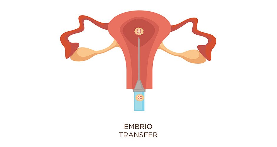 Embryo Transfer Procedure in Mumbai